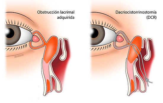 Obstrucción adquirida del lagrimal